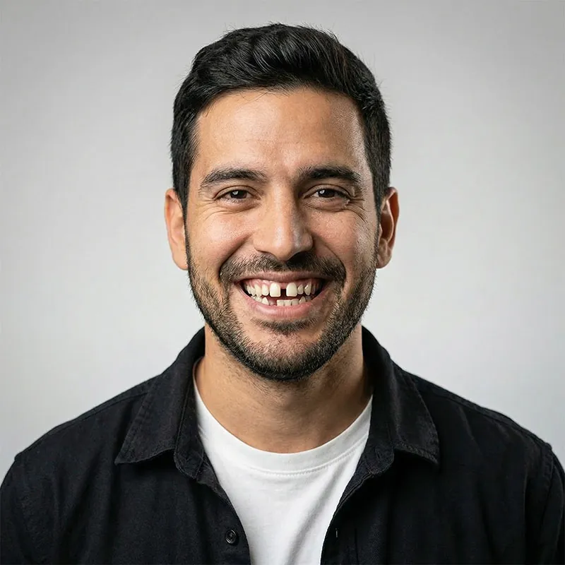 Roberto before porcelain veneers