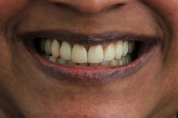 Teeth after treatment