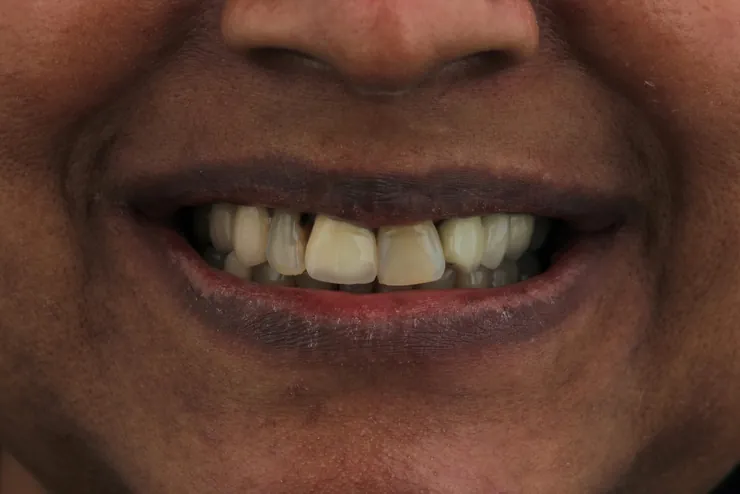Teeth before treatment