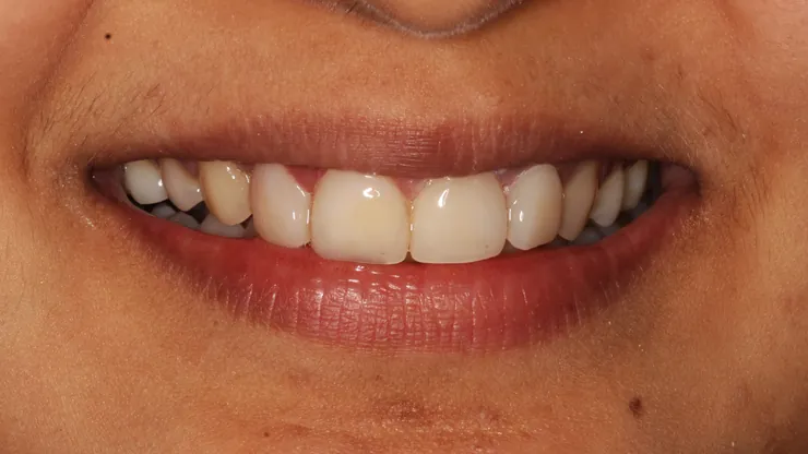 Teeth after treatment