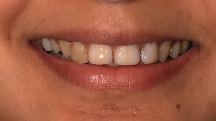 Teeth before treatment