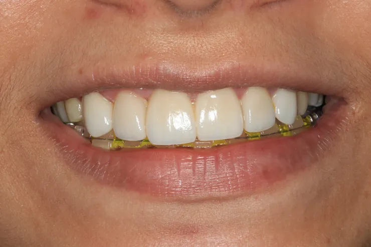 Teeth after treatment