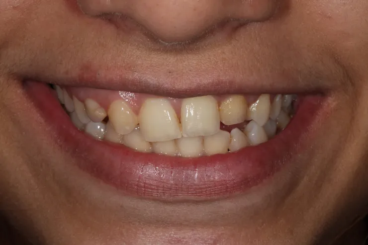 Teeth before treatment